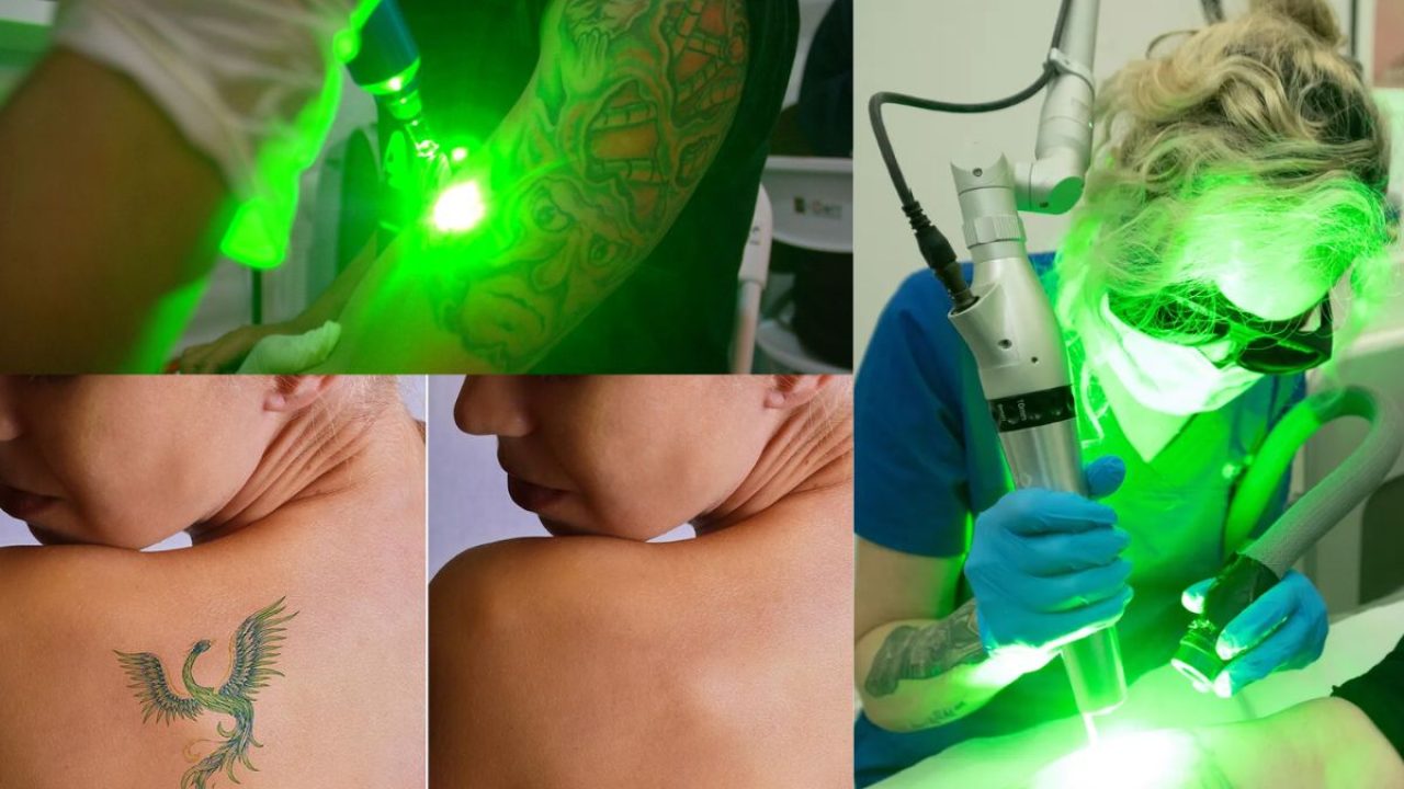 Tattoo Removal – Ramana Cosmetic Surgery