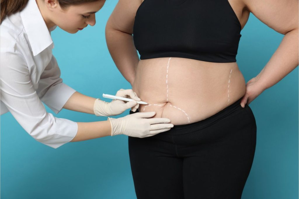 Non-Surgical Liposuction Dubai