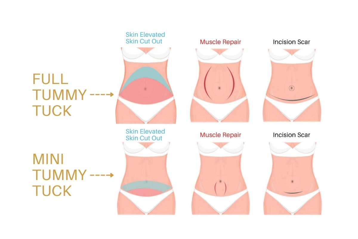 Mini Tummy Tuck